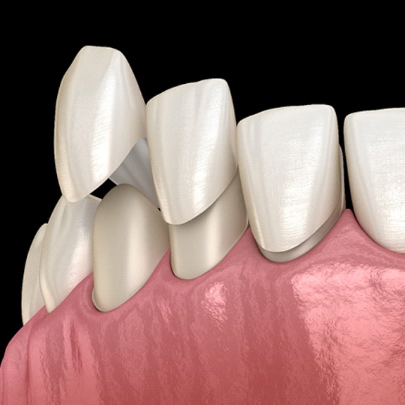 Illustration of veneers being placed on front teeth