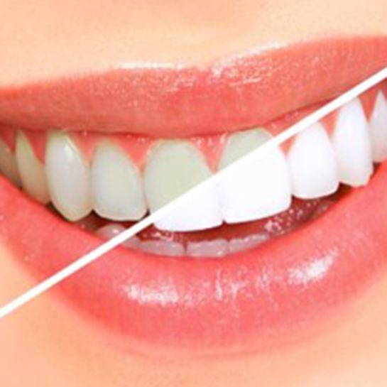 Side-by-side comparison of stained and whitened teeth in Weatherford, TX