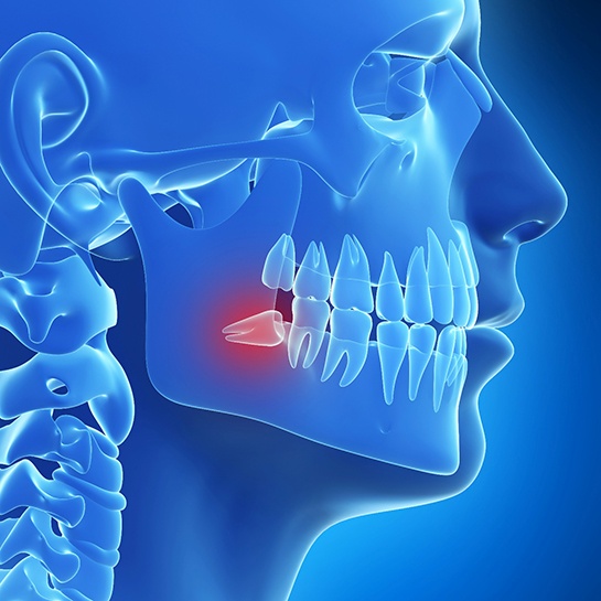 digital model showing crooked wisdom tooth 
