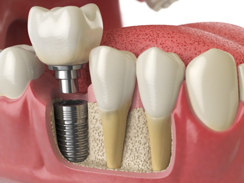 Diagram of a dental implant’s components inside the jaw