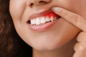 Woman lifting her gums to see they are red