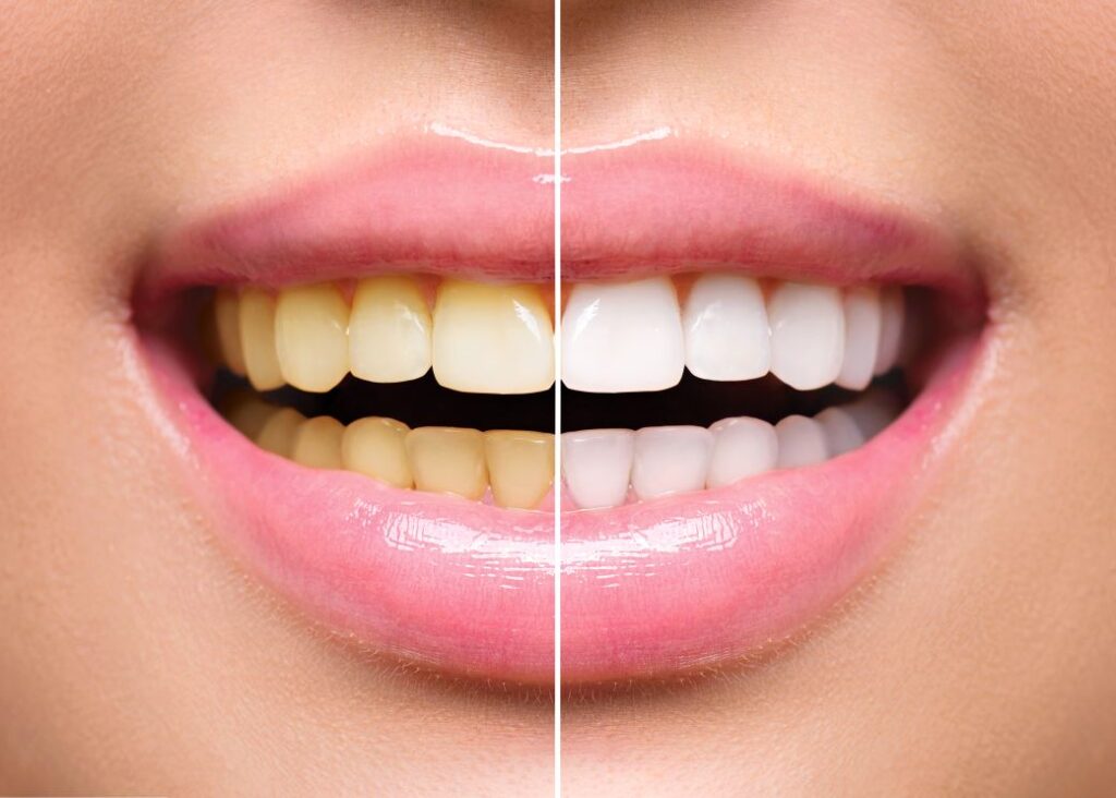 A woman’s smile before and after professional whitening